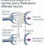 Parkinsonova choroba – symptomy, prevence a diagnostika