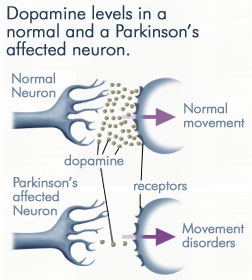 Parkinsonova choroba - symptomy, prevence a diagnostika