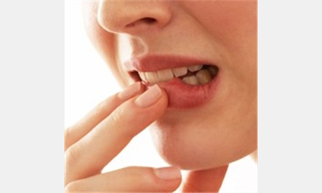 Afty - nepříjemné postižení ústní sliznice - jak na afty?