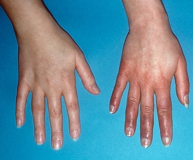 Zdravá ruka vs. ruka s akrocyanózou