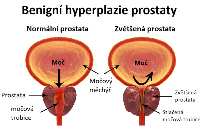 Benigní hyperplazie prostaty - ilustrace