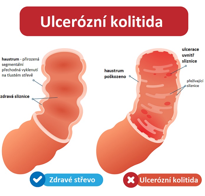 Ulcerózní kolitida - ilustrace