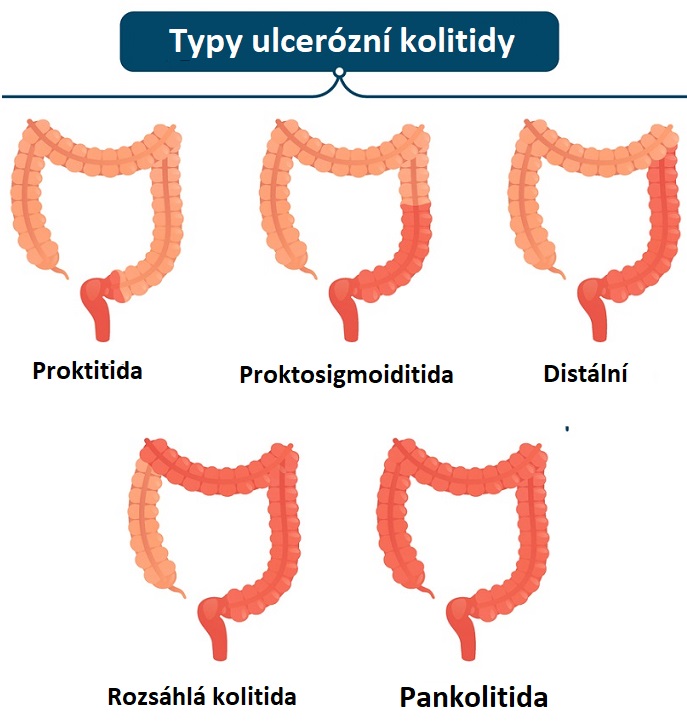 Typy ulcerózní kolitidy - ilustrace