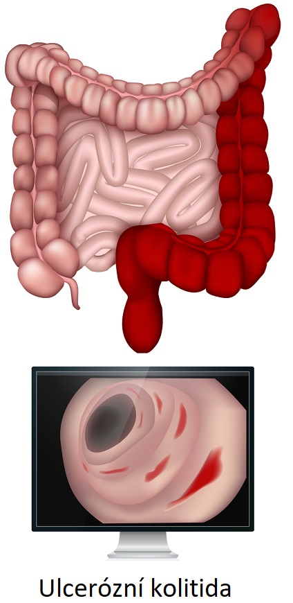 Ulcerózní kolitida - ilustrace
