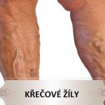 Křečové žíly – příznaky, příčiny a léčba