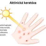 Aktinická keratóza (solární keratóza) – příčiny, příznaky a léčba