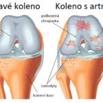 Osteoartróza kolene – příznaky, příčiny a léčba