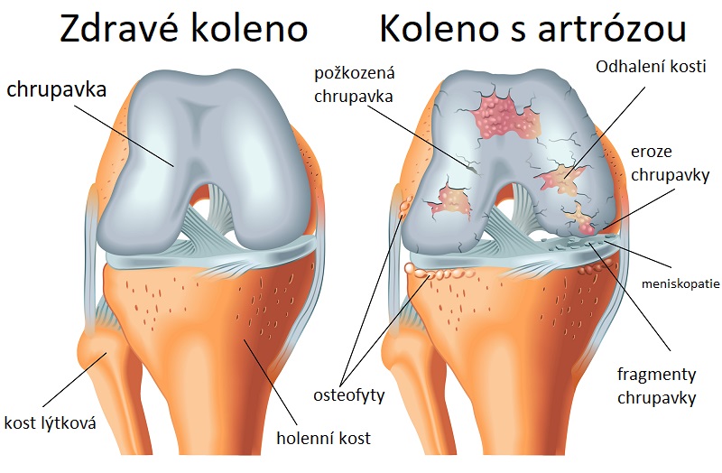Artróza - ilustrace