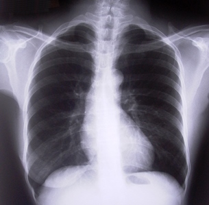 Zápal plic (pneumonie)