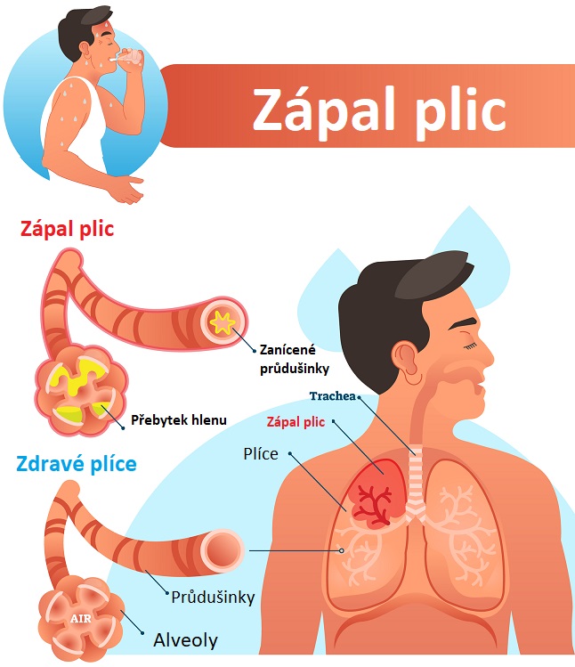 Zápal plic - ilustrace