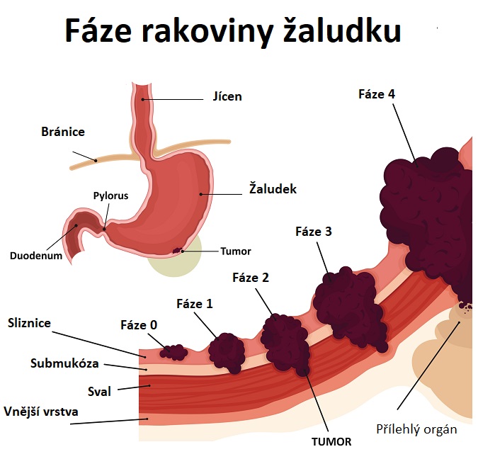 Fáze rakoviny žaludku