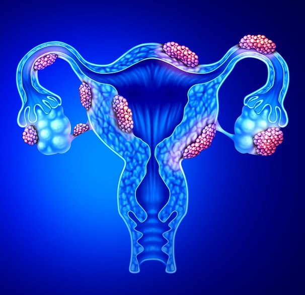 Endometrióza je gynekologické onemocnění, při kterém se tkáň podobná výstelce dělohy (endometrium), nachází mimo dělohu.