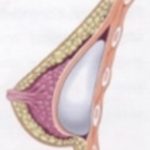 Vliv prsních implantátů na kojení