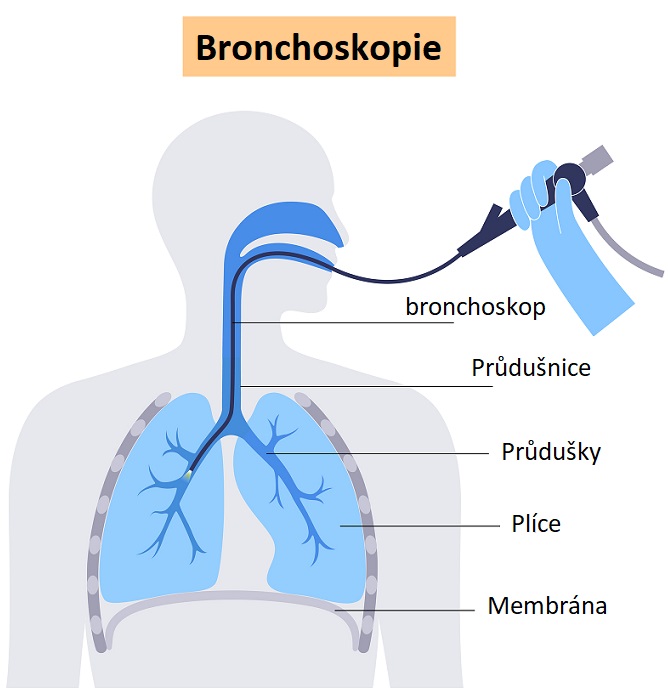 Bronchoskopie - ilustrace