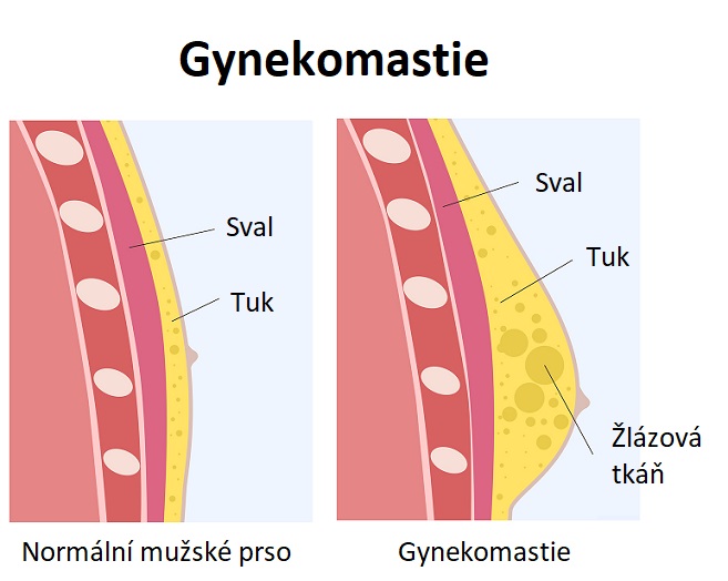 Gynekomastie - ilustrace