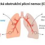 Léčba kmenovými buňkami u chronické obstrukční plicní nemoci (CHOPN)