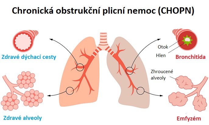 Chronická obstrukční plicní nemoc (CHOPN)  - ilustrace