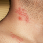 Pásový opar (herpes zoster) – příčiny, příznaky, léčba