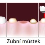 Náhrady zubů – jaké máte možnosti?