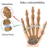 Osteoartróza (artróza) – jak na ni – příznaky, příčiny a léčba