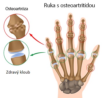 jak zastavit artrózu