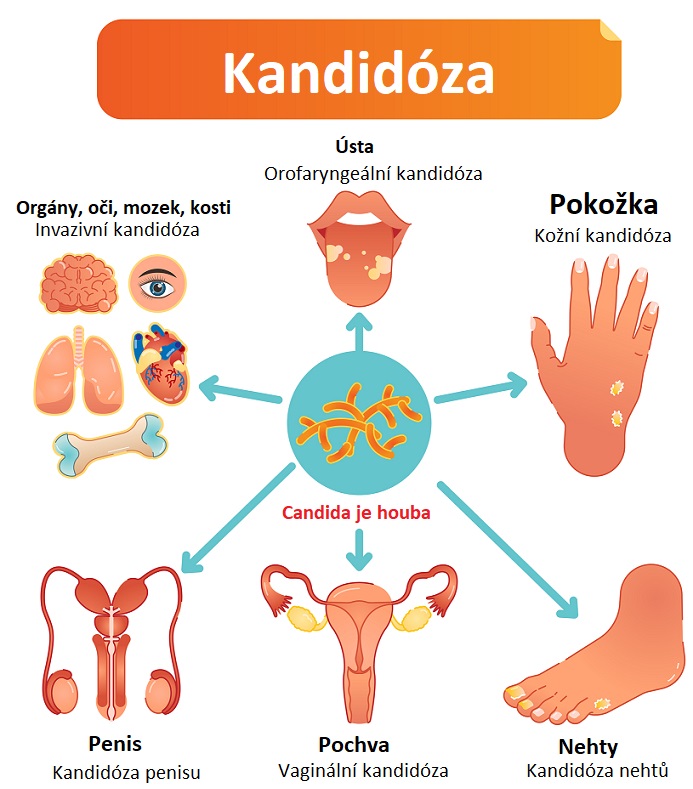 Candida albicans - kandidóza - ilustrace