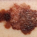 Rakovina kůže – časté mýty a omyly