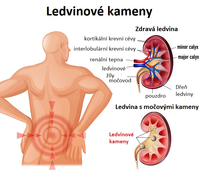 Ledvinové kameny - ilustrace