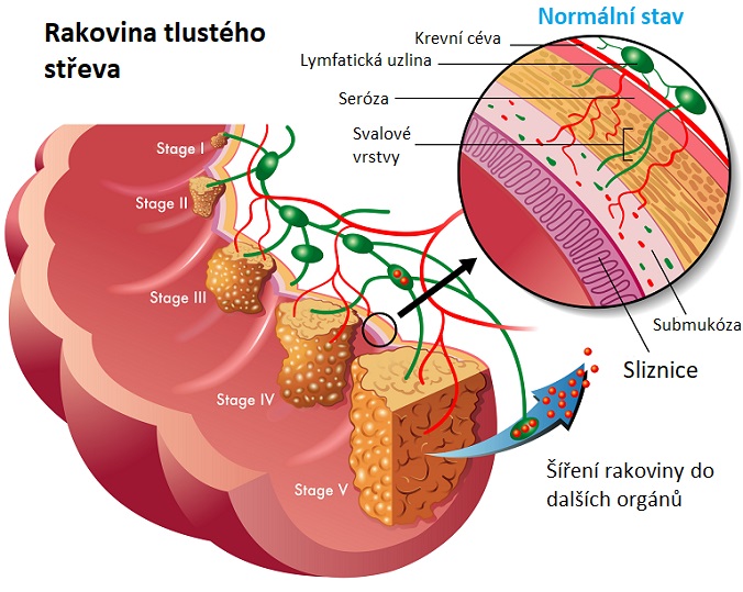 Rakovina tlustého střeva - ilustrace