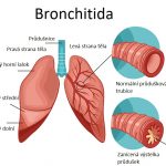 Je bronchitida nakažlivá?