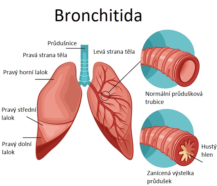 Bronchitida - ilustrace
