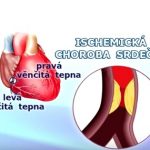 Ischemická choroba srdeční a vše o ní – příznaky, příčina a léčba