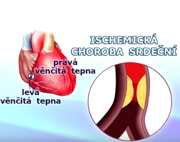 Ischemická choroba srdeční a vše o ní - příznaky, příčina a léčba