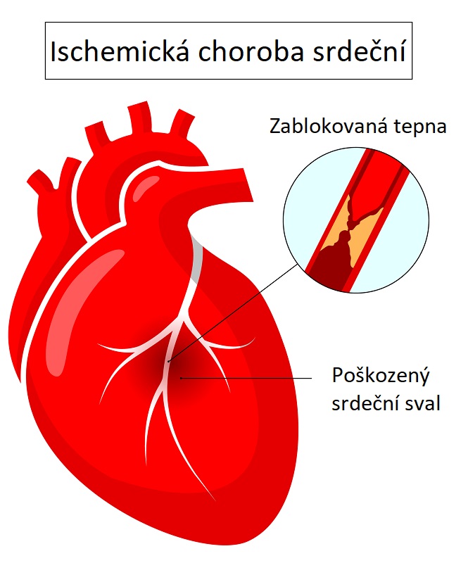 Nejčastější příčinou ischemické choroby srdeční (anginy pectoris) je ateroskleróza. Ateroskleróza je postupné hromadění plaků v koronárních tepnách, což jsou tepny, které zásobují srdce krví. 