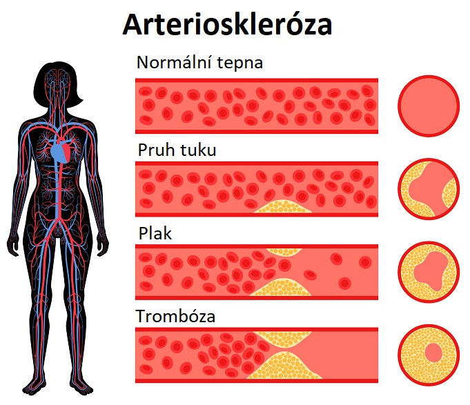 Fáze arteriosklerózy - ilustrace