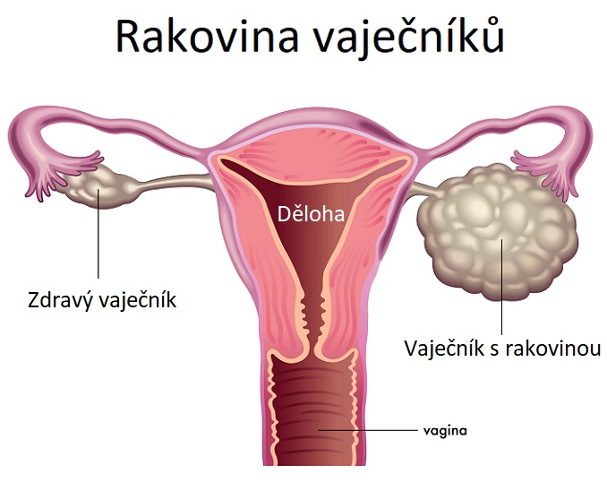 Rakovina vaječníků - ilustrace