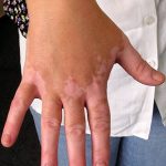 Vitiligo – léčba a příznaky nemoci bílých skvrn