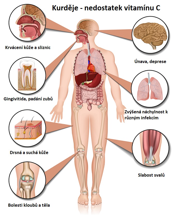 Příznaky kurdějí (nedostatku vitamínu C) - ilustrace