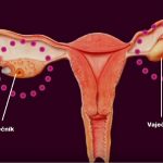 Rakovina vaječníků – příznaky, projevy, léčba