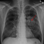 Rakovina (karcinom) plic – příčiny, příznaky, léčba