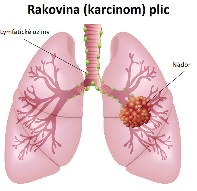 Rakovina plic - ilustrace