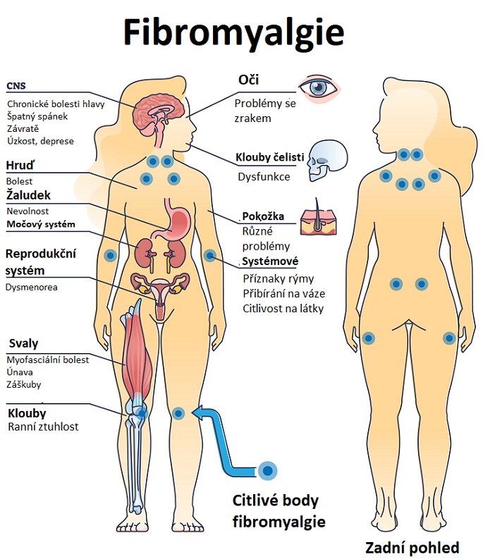 Fibromyalgie - ilustrace