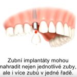 Umělé zuby (zubní implantáty) nebo snímatelná protéza?