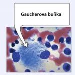 Gaucherova choroba – příznaky, příčiny a léčba