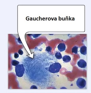 Gaucherova choroba - vzácné onemocnění