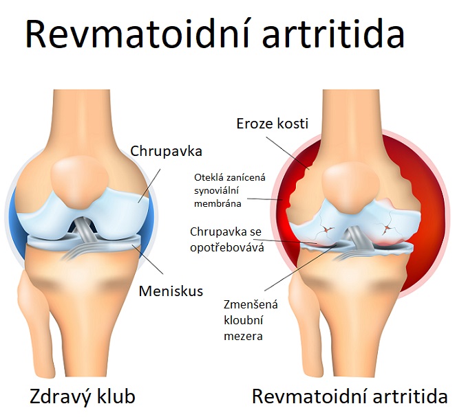 Revmatoidní artritida - ilustrace