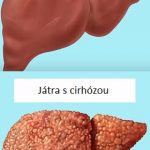 Cirhóza jater – co je to – příčiny, příznaky, léčba