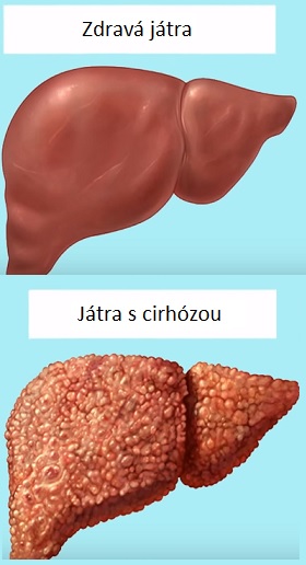 Cirhóza jater