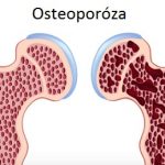 Jak se vyhnout osteoporóze: Starodávný domácí lék na osteoporózu