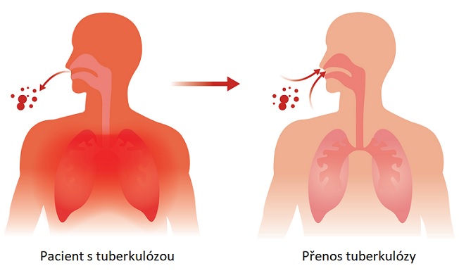 Přenos tuberkulózy - ilustrace